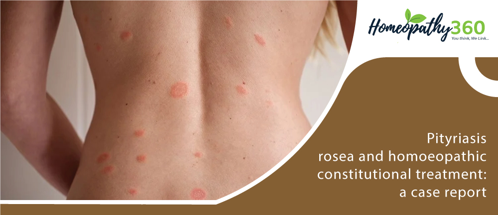 Pityriasis Rosea Symptoms Causes Treatment Images