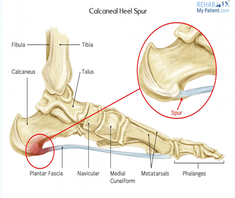 PDF) Evaluation of Heel pain in association with Calcaneal spur Length and  Angle