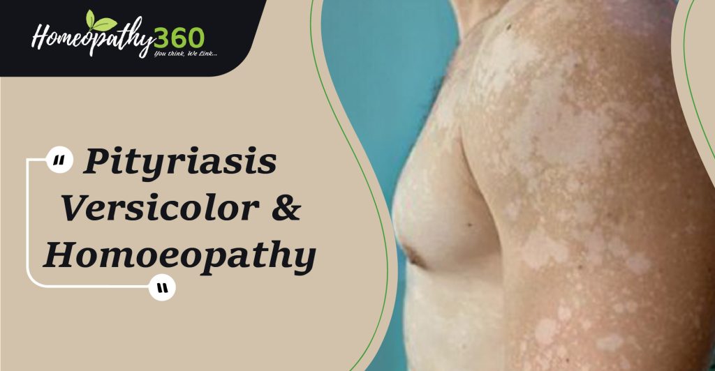 Pityriasis Versicolor And Homoeopathy - Dr. Hemant Masar