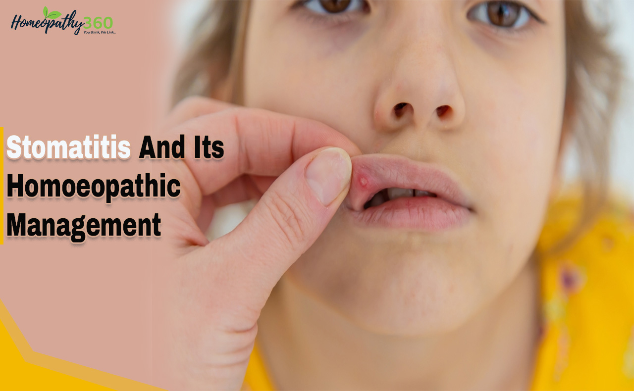 Stomatitis Symptoms Causes Pictures And Treatment With Homeopathy