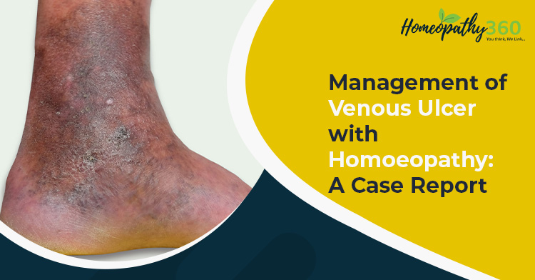 Venous Ulcer homeopathy360