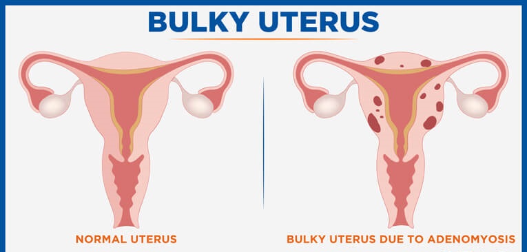 What is Bulky Uterus? its Symptoms, Causes and Treatments
