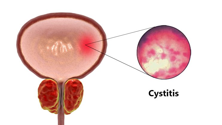 Cystitis And Homoeopathy Homeopathy360