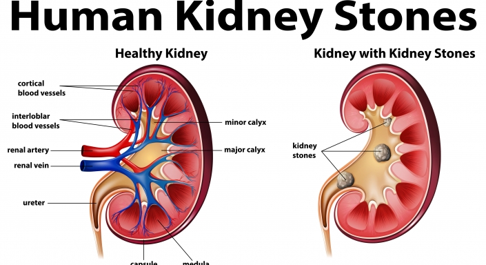 Nephrolithiasis And Homoeopathic Approach Homeopathy360